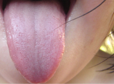 Importance of the Tongue in Traditional Chinese Medicine